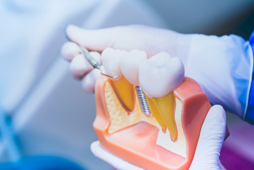 EM-Dent