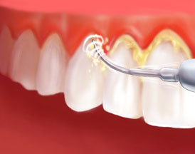 Dentes